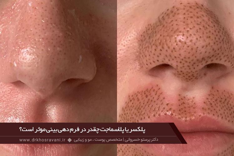 پلکسر یا پلاسماجت چقدر در فرم دهی بینی موثر است؟
