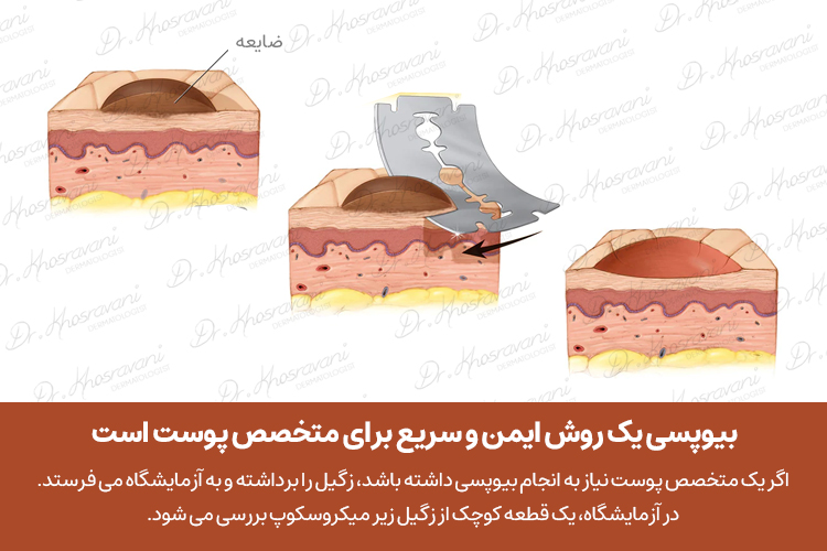 بیوپسی زگیل کرایوتراپی زگیل زگیل تناسلی دکتر پرستو خسروانی بهترین متخصص پوست، مو و زیبایی