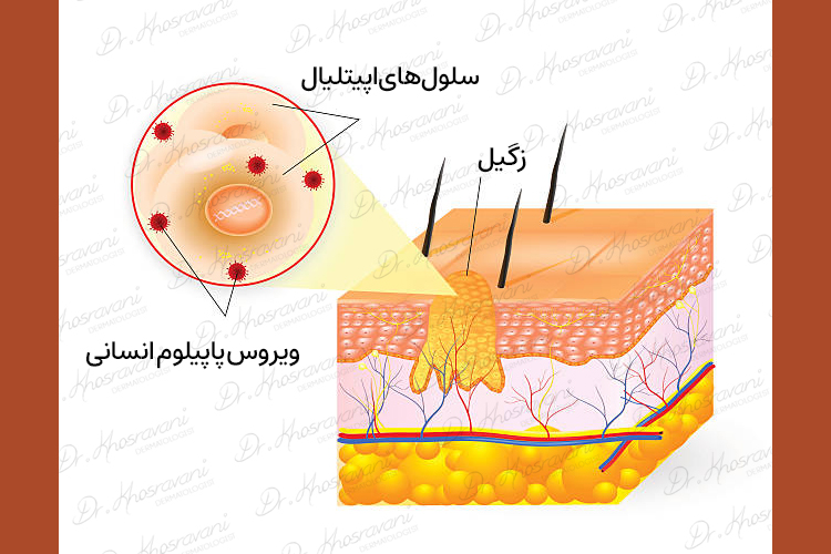 درمان زگیل زگیل تناسلی دکتر پرستو خسروانی بهترین متخصص پوست، مو و زیبایی شهرکرد