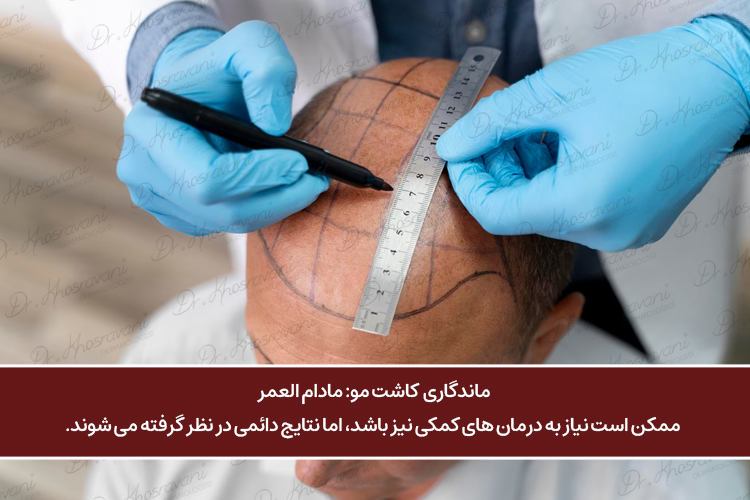 ماندگاری کاشت مو مادام العمر است دکتر پرستو خسروانی بهترین متخصص پوست، مو و زیبایی شهرکرد کاشت مو