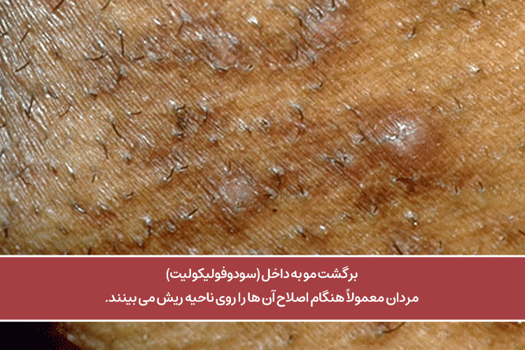 سودوفولیکولیت برگشت مو به داخل دکترپرستو خسروانی بهترین متخصص پوست، مو و زیبایی شهرکرد