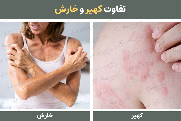 تفاوت کهیر و خارش پوستی درمان خارش و کهیر دکتر پرستو خسروانی بهترین متخصص پوست، مو و زیبایی