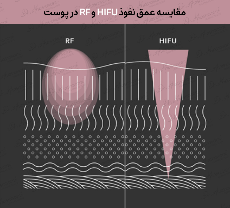 مقایسه هایفو و آر اف