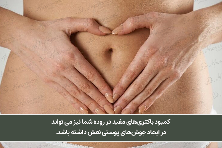 تاثیر باکتریهای روده در ایجاد جوش