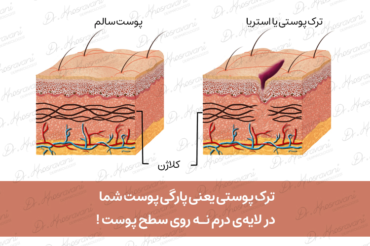 سخت بودن درمان ترک پوست