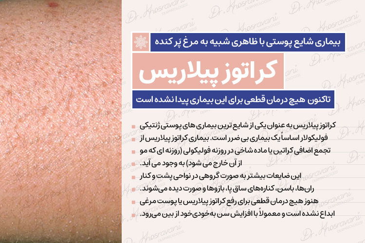 درمان کراتوس پیلاریس در اصفهان