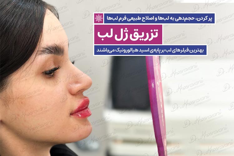 حجیم سازی لب با تزریق ژل