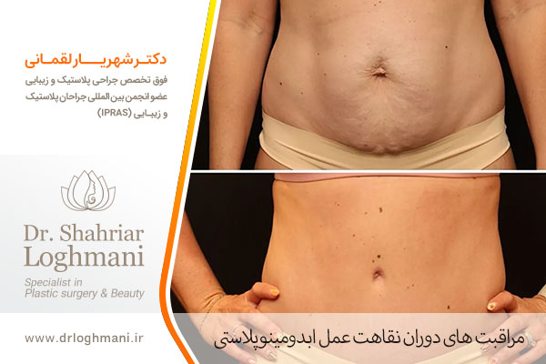 دوره نقاهت ابدومینوپلاستی