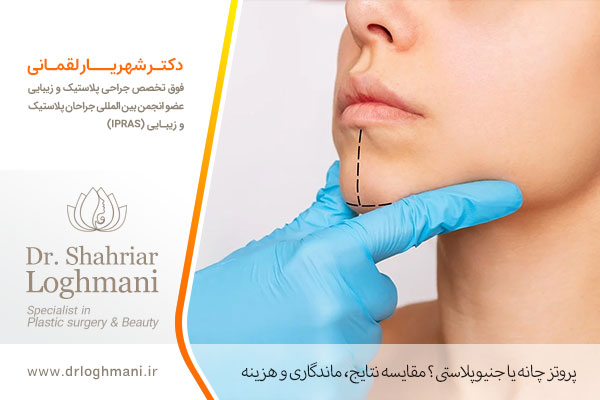 پروتز چانه یا جنیوپلاستی