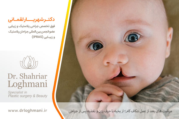 مراقبت بعد از عمل شکاف کام