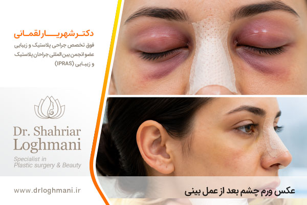 عکس ورم چشم بعد از عمل بینی 