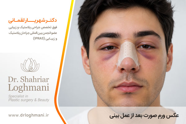 عکس ورم صورت بعد از عمل بینی 