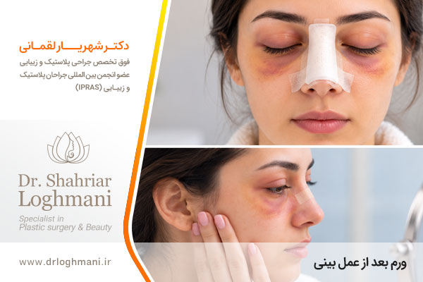 عکس ورم بعد از عمل بینی 
