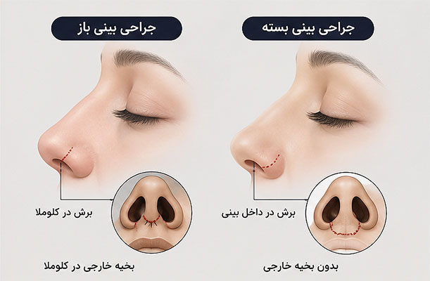 بخیه عمل بینی