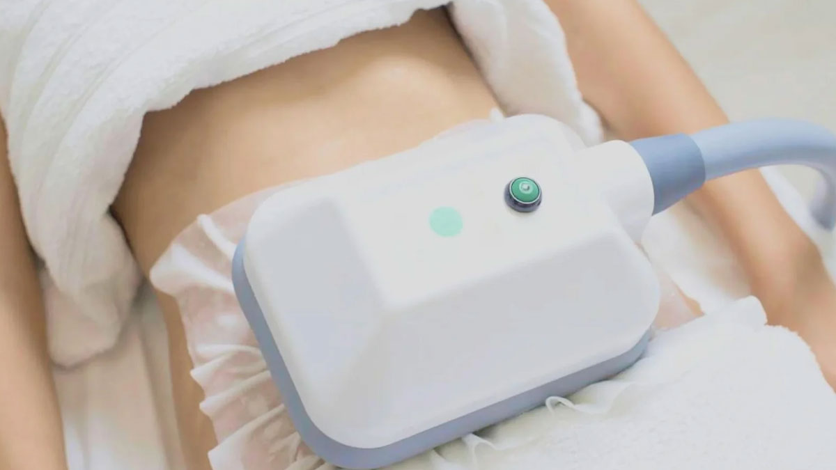 کرایولیپولیز 