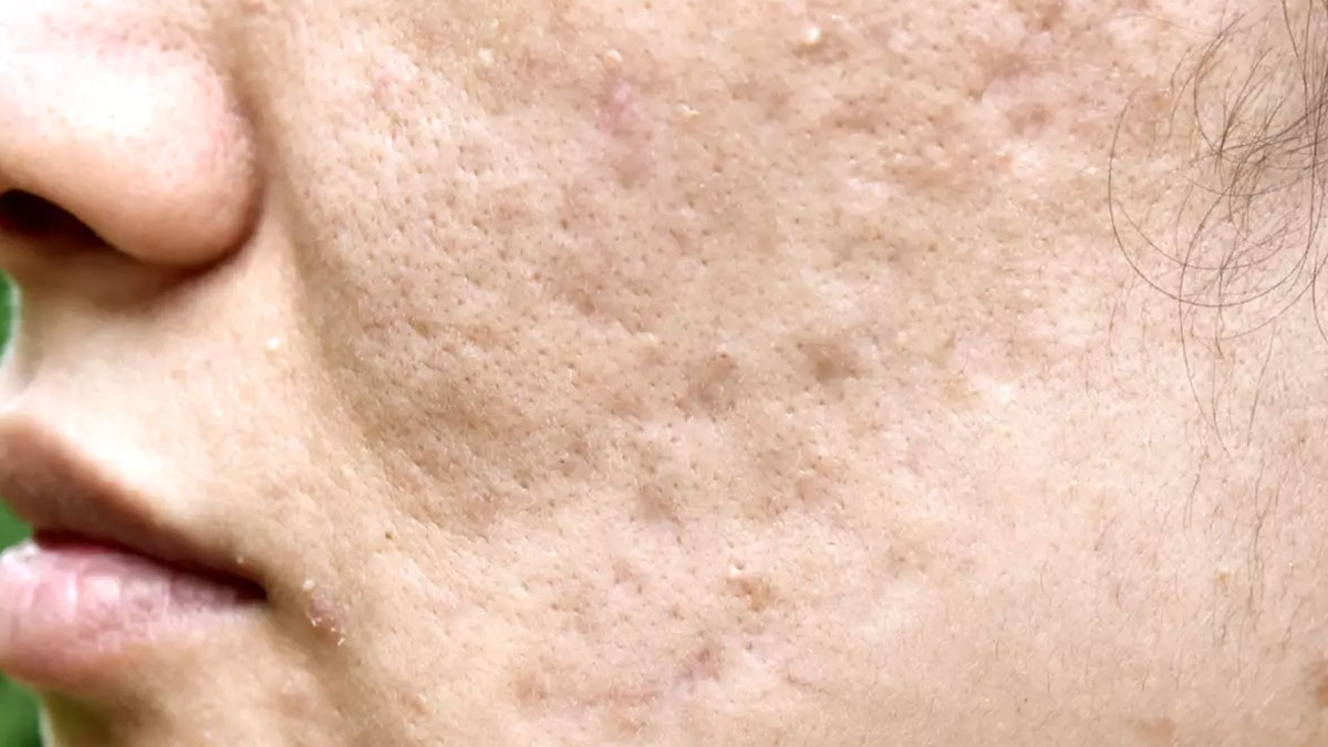 سابسیژن صورت 