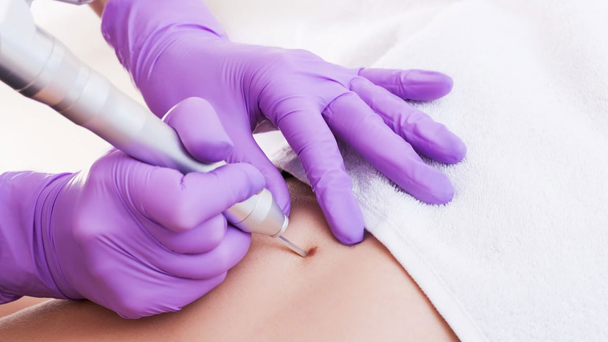 کرایوتراپی 