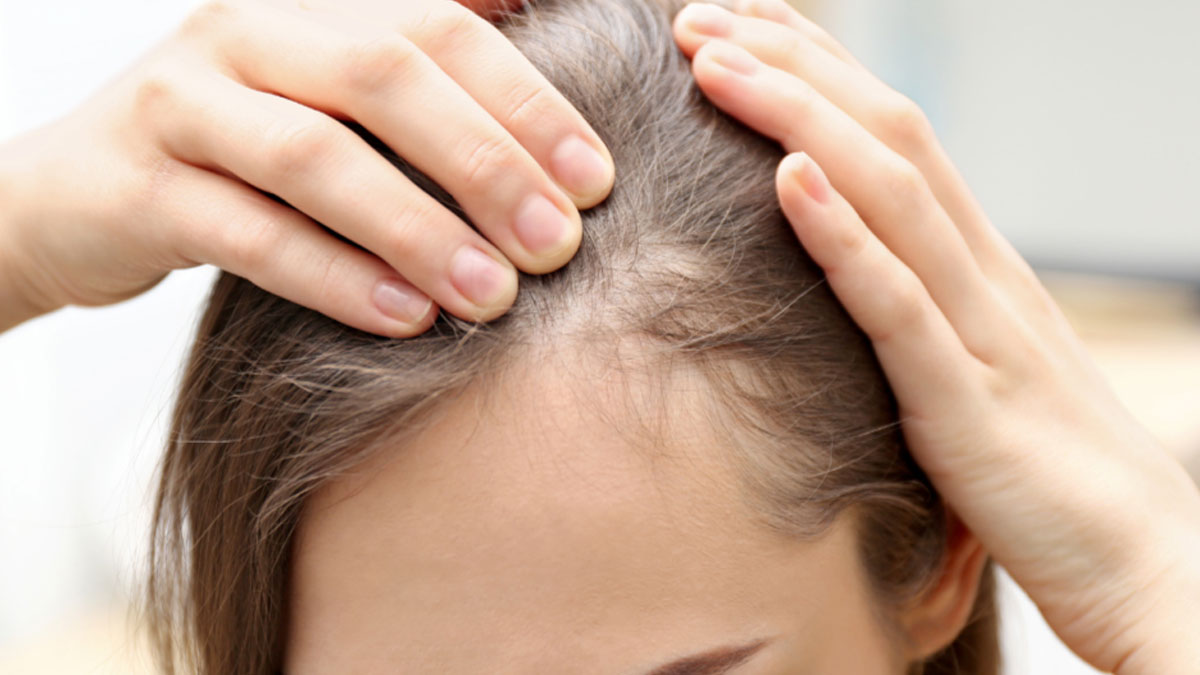 مزونیدلینگ مو 