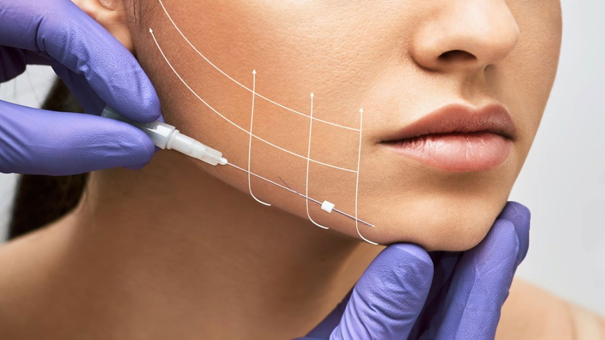 لیفت صورت با نخ 