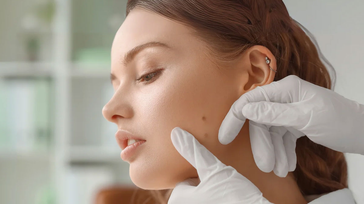 برداشتن خال 