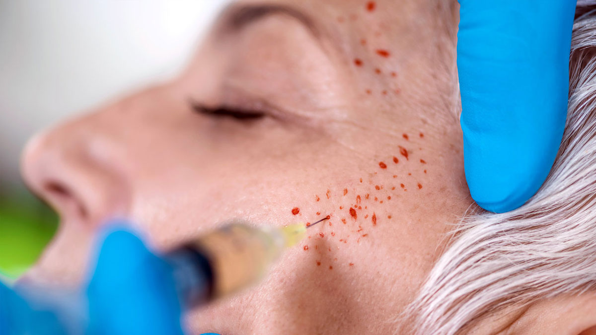 پی آر پی صورت