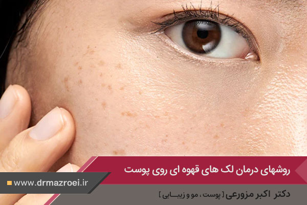 درمان لک های قهوه ای روی پوست