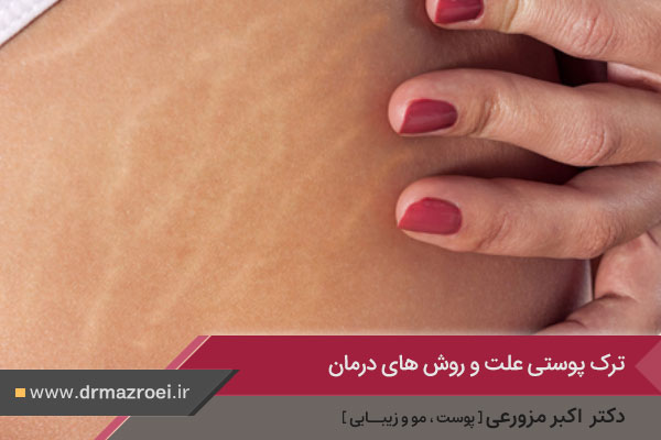 عکس ترک پوستی یا استریا