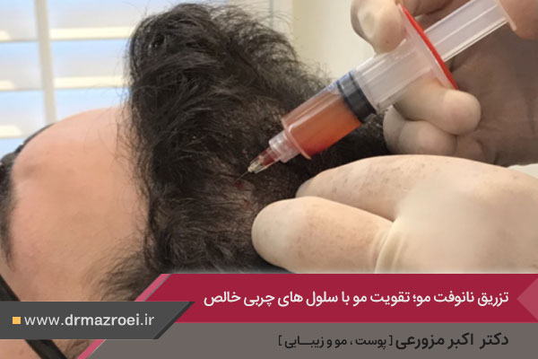 درمان ریزش مو با نانوفت