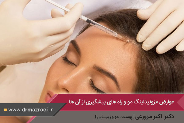 عوارض مزونیدلینگ مو چیست؟