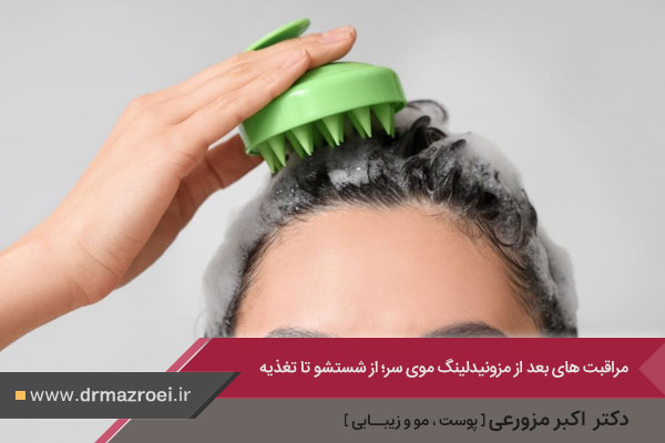 مراقبت بعد از مزونیدلینگ مو