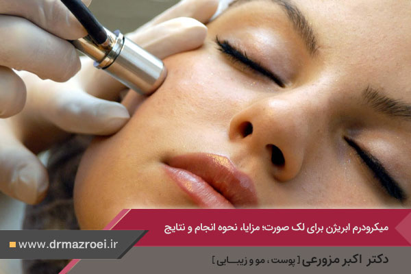 میکرودرم ابریژن برای لک صورت 