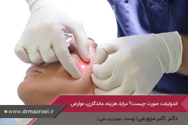 اندولیفت صورت چیست