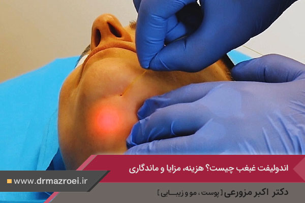 اندولیفت غبغب چیست