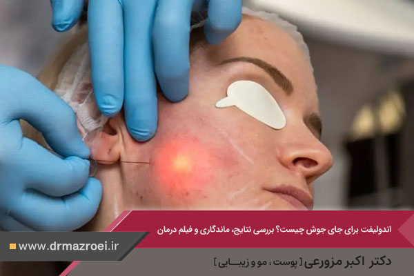 اندولیفت جای جوش 