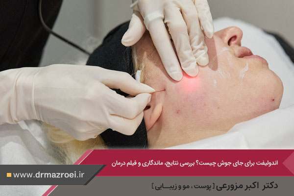 اندولیفت برای جای جوش 