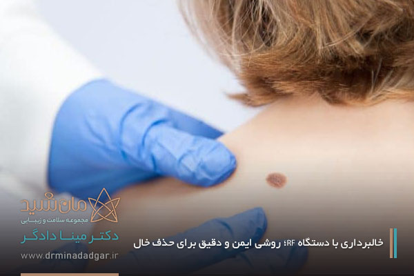 خال برداری با دستگاه آر اف الکتروسرجری
