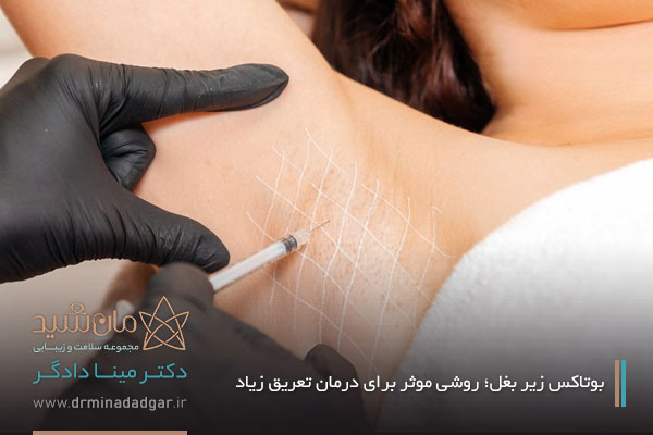 بررسی بوتاكس زير بغل