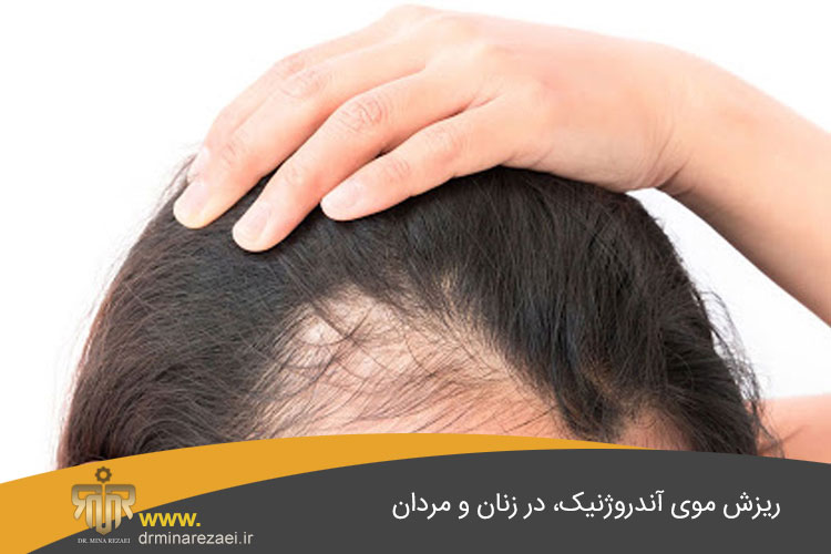 ریزش موی آندروژنیک