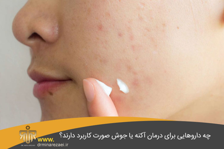 جوش صورت