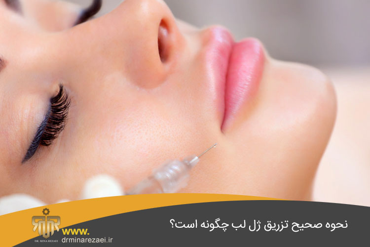 تزریق ژل لب
