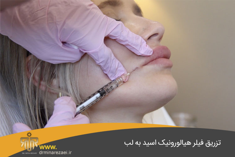 تزریق فیلر لب
