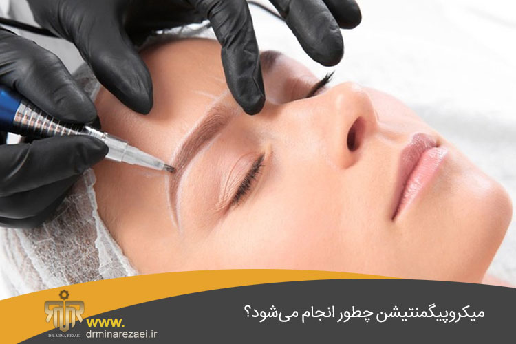 میکروپیگمنتیشن
