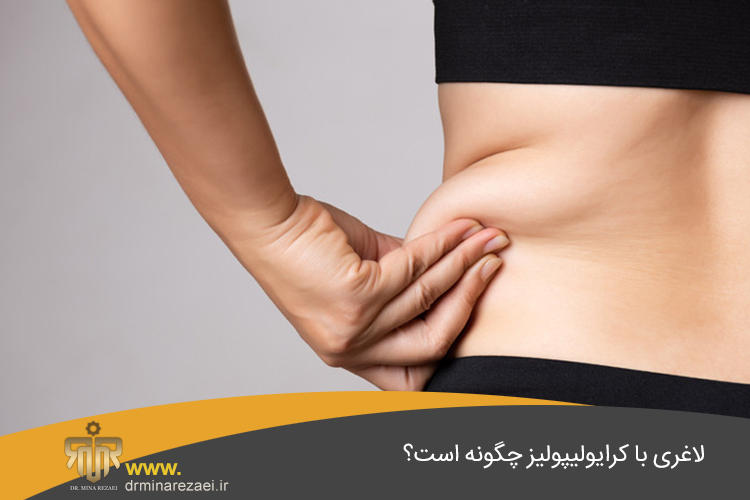 لاغری با کرایولیپولیز