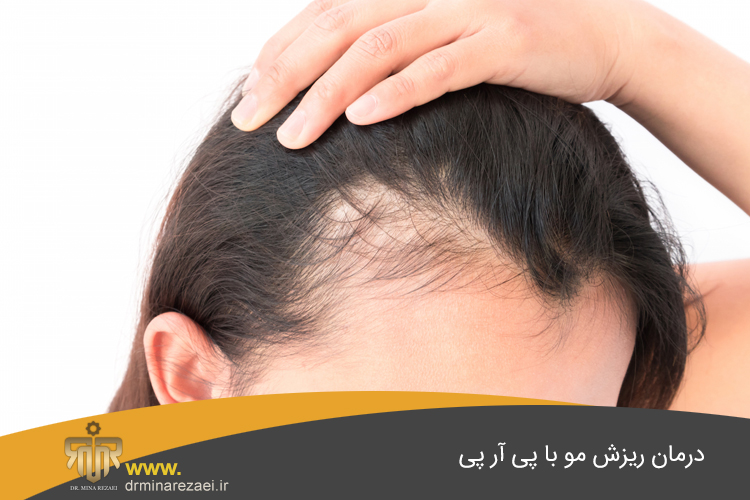 درمان ریزش مو با پی آر پی 