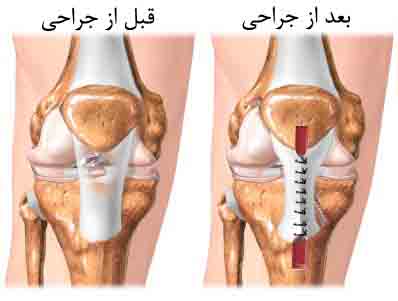 درمان آسیب های رباط صلیبی در اصفهان | کشیدگی رباط صلیبی | دکتر مهدی مؤیدفر