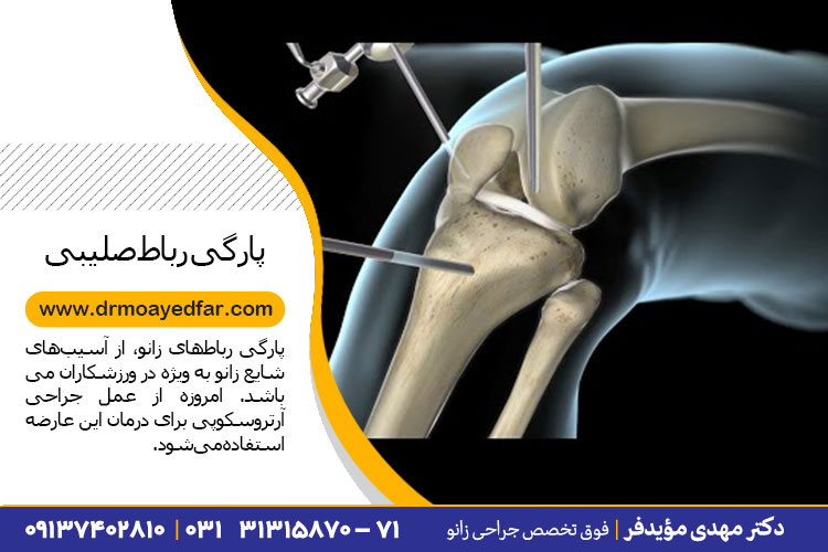 جراحی رباط صلیبی قدامی در اصفهان