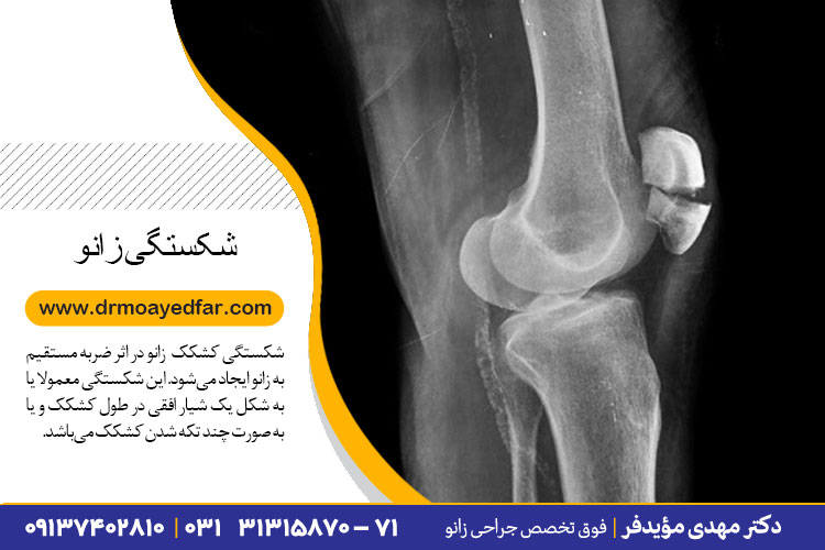 درمان شکستگی کشکک زانو در اصفهان