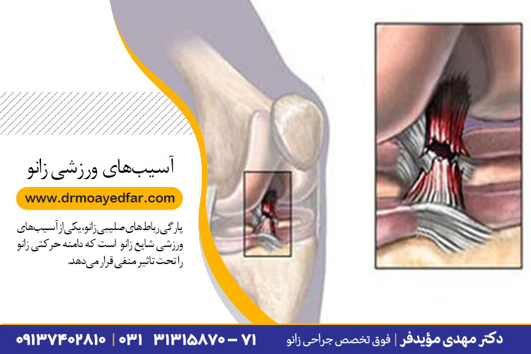 آسیب های شایع زانو