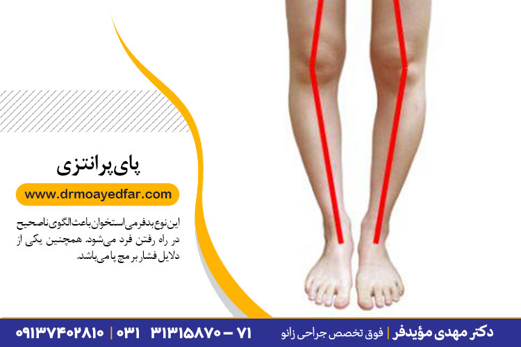 درمان پای پرانتزی در اصفهان