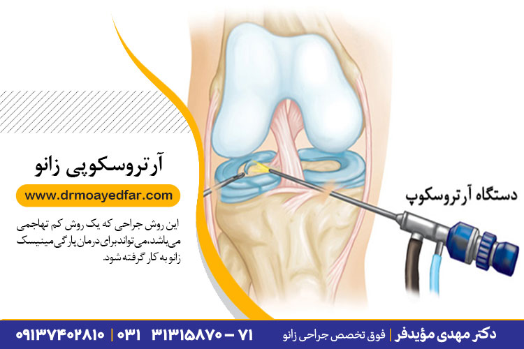 بهترین جراحی آرتروسکوپی در اصفهان